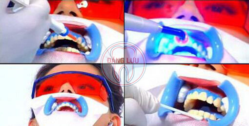 Tẩy trắng răng bằng phương pháp chiếu đèn kết hợp thuốc tẩy