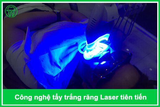 tẩy trắng răng bằng công nghệ Laser