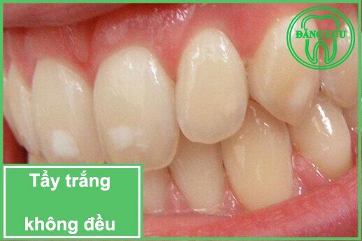Cách xử lý khi tẩy trắng răng không đều màu