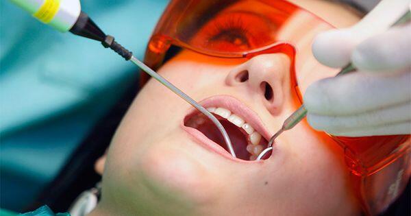Lấy cao răng nhiều lần có tốt không ?