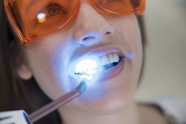 tẩy trắng răng tại nha khoa