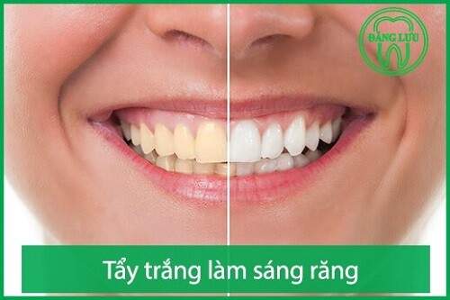 Tẩy trắng răng mất bao lâu thời gian ? 1