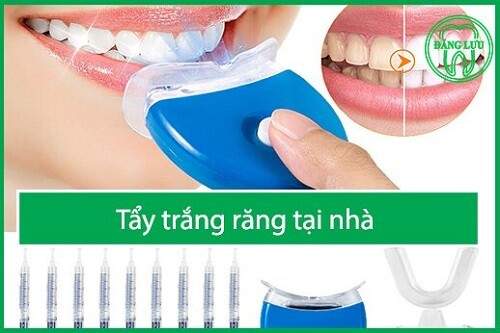 Tẩy trắng răng tại nhà hiệu quả với máng tẩy trắng 1