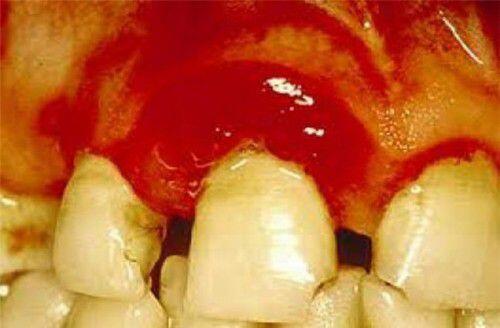Hậu quả của đau răng do viêm tủy răng