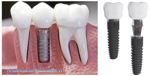 Trồng răng implant ở đâu TP.HCM