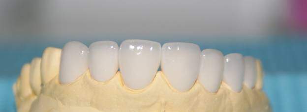 Thời gian bảo hành răng sứ Zirconia là bao nhiêu năm?