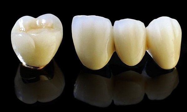 Thời gian bảo hành răng sứ Titan là bao nhiêu năm?