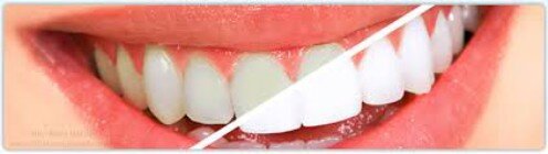 Thông tin hữu ích về tẩy trắng răng tại nhà