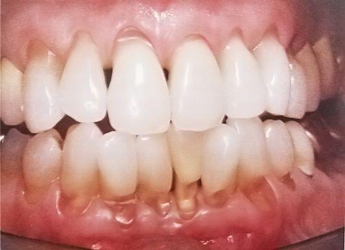 Hậu quả khôn lường từ việc tẩy trắng răng siêu tốc