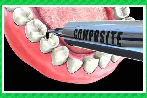 Trám răng bằng vật liệu Composite có thật tốt không?