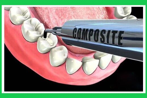 Thời gian sử dụng của răng trám composite