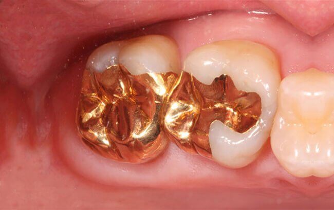 Các loại vật liệu trám răng mà bác sĩ khuyên dùng