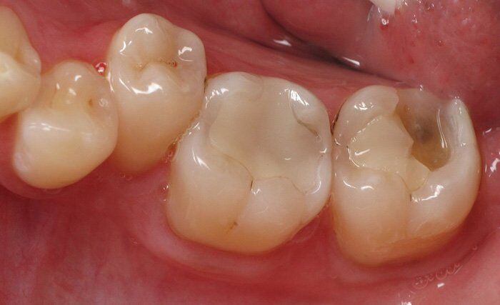 trám răng Composite có những ưu điểm gì
