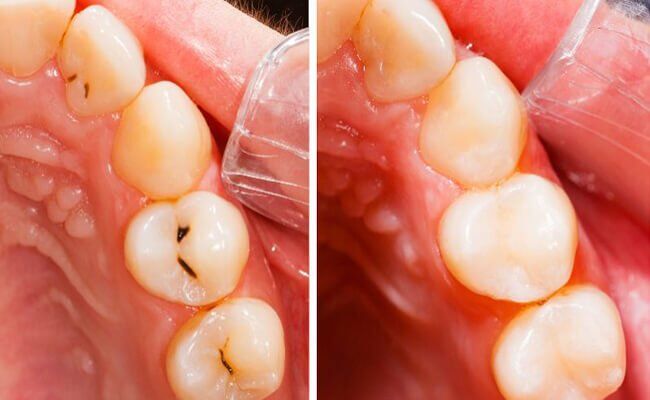 Sâu răng có nguy hiểm không? Sâu răng điều trị như thế nào?