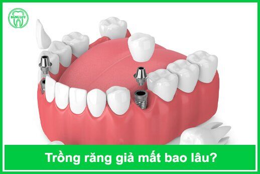 Trồng răng giả mất thời gian bao lâu để hoàn tất ?