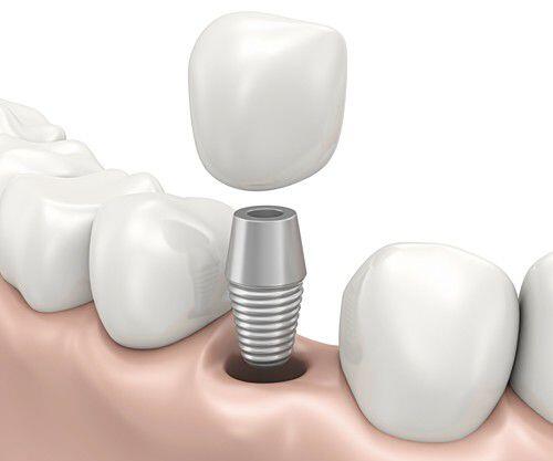 Trồng răng implant bao lâu thì bình phục ?