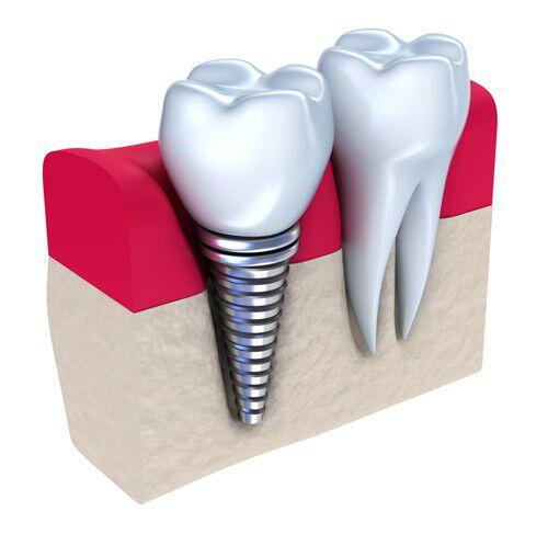 Trồng răng implant có đau và nguy hiểm không ?