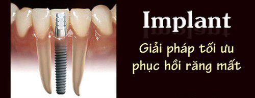 Trồng răng Implant có giá bao nhiêu tiền