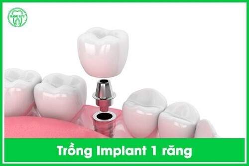 Trồng răng Implant trả góp 0% lãi suất tại TPHCM 1