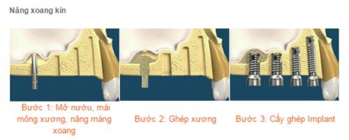 Trồng răng implant kết hợp nâng xoang hàm và ghép xương