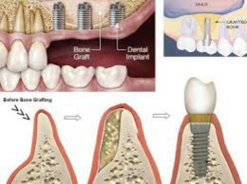Tại sao cần nâng xoang hàm trong cắm ghép implant ?