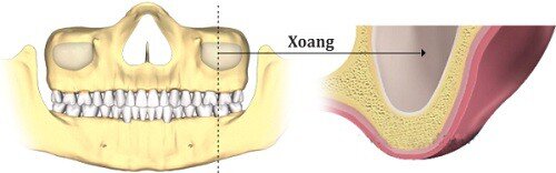 Trồng răng implant kết hợp nâng xoang hàm và ghép xương