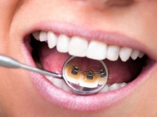 Tuổi tác có ảnh hưởng đến kết quả niềng răng ?
