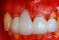 Thói quen xỉa răng và bệnh lý răng miệng