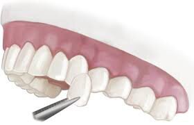 ưu điểm bọc răng sứ so với trám răng