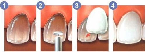  Phương pháp chữa triệt để vàng răng do yếu tố nội sinh