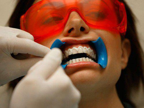 Tẩy trắng răng bằng đèn plasma có ảnh hưởng tới men răng