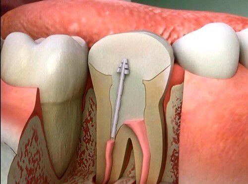 Vì sao răng chữa tủy lại gọi là răng chết ? 