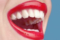 Các vấn đề mà bạn chưa biết khi tẩy trắng răng