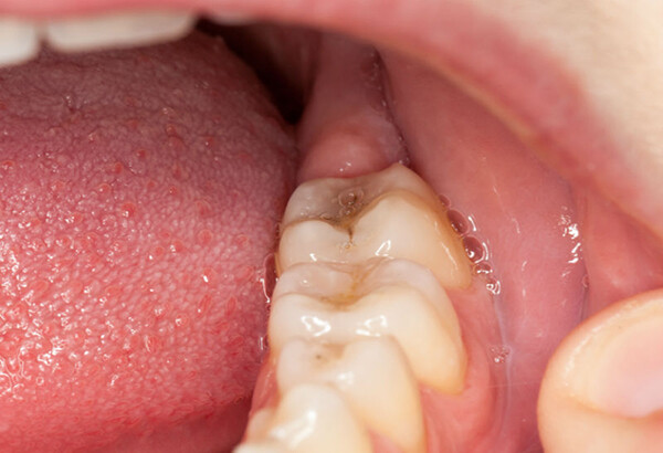 nhổ răng khôn điều trị viêm lợi trùm
