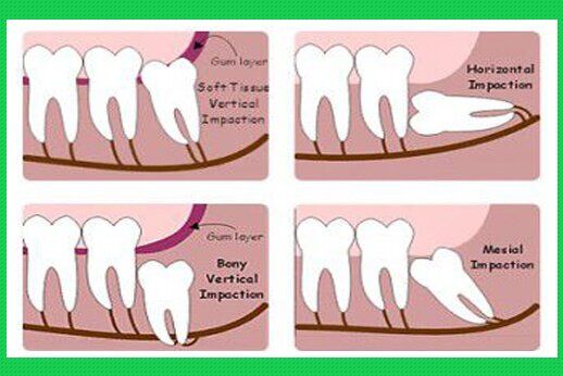 Mối liên quan giữa răng số 8 và bệnh viêm lợi trùm