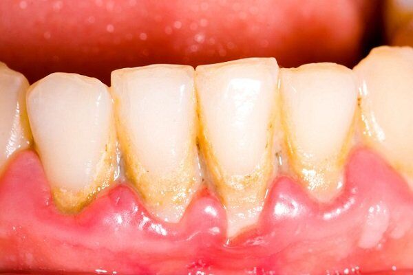 Bệnh nha chu không chỉ gây mất răng-1
