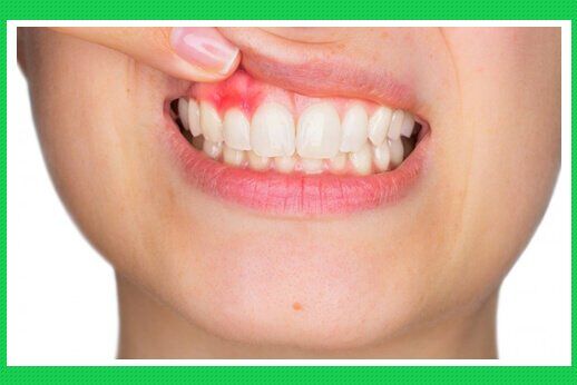 Tác hại của bệnh viêm nướu răng và biện pháp phòng tránh