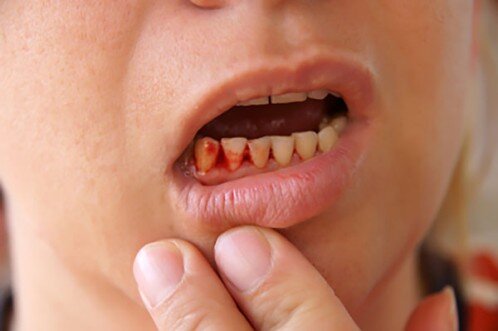 Chữa viêm chân răng bằng thuốc nam
