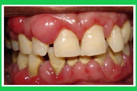Viêm quanh răng là bệnh gì?