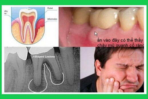 Viêm quanh răng là bệnh gì?