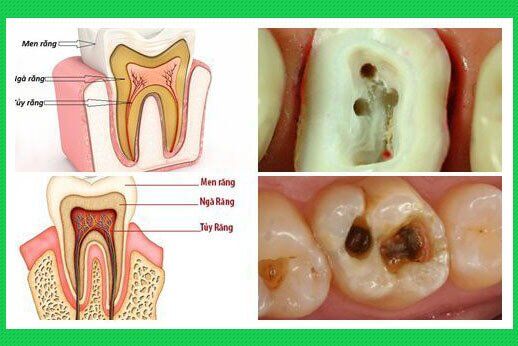 Nguyên nhân và triệu chứng của bệnh viêm tủy răng