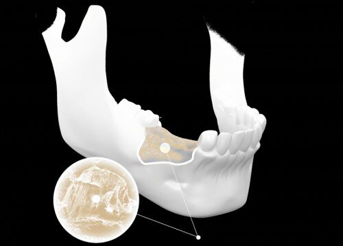 Viêm xoang hàm ảnh hưởng thế nào đến răng ?