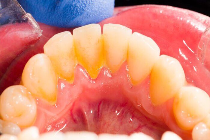 vôi răng nguyên nhân chính gây ra hôi miệng