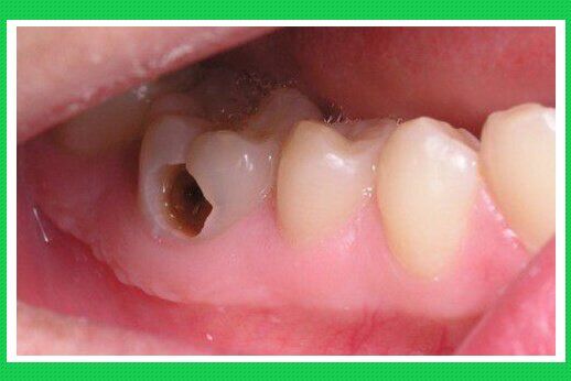 Khi nào cần chữa tủy răng? và những hậu quả khó lường do viêm tủy răng