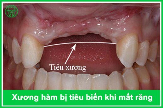 Tại sao phải phẫu thuật nâng xoang hàm khi ghép răng ?