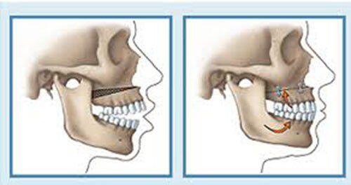 Ghép xương trong implant là gì ?