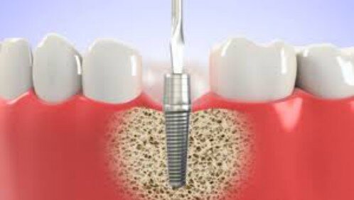 Những đối tượng không nên làm răng implant